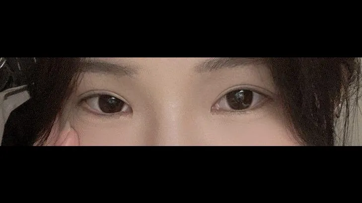 Incisional Double Eyelid Surgery, Ptosis Correction — RE&RE PLASTIC SURGERY 4