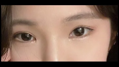 Incisional Double Eyelid Surgery, Ptosis Correction — RE&RE PLASTIC SURGERY 5