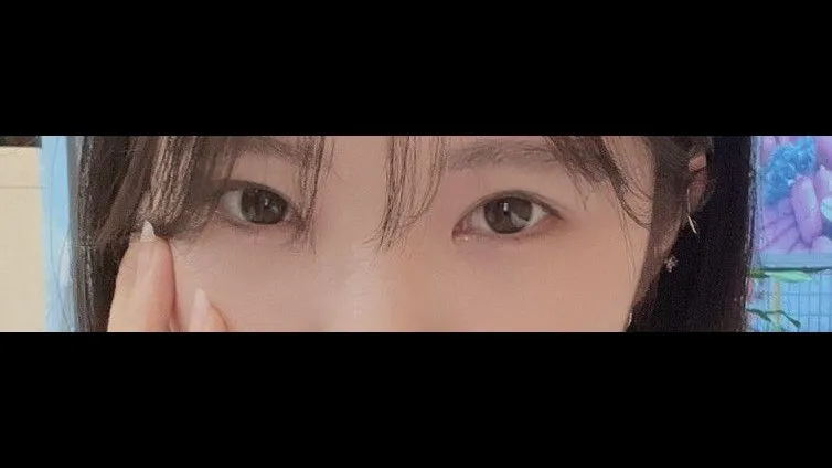 Incisional Double Eyelid Surgery, Ptosis Correction — RE&RE PLASTIC SURGERY 6