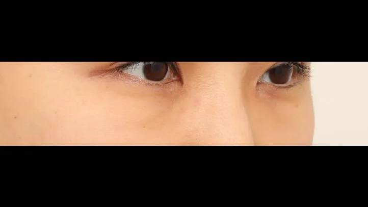 Lower Blepharoplasty (Aging Eye Rejuvenation), Midface Lift, Facial Fat Grafting — RE&RE PLASTIC SURGERY 1