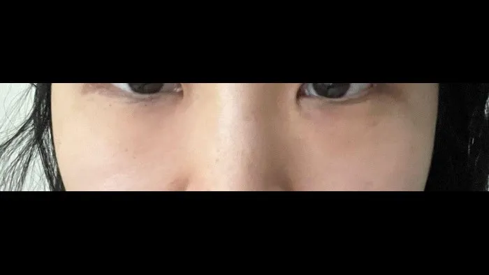 Lower Blepharoplasty (Aging Eye Rejuvenation), Midface Lift, Facial Fat Grafting 2