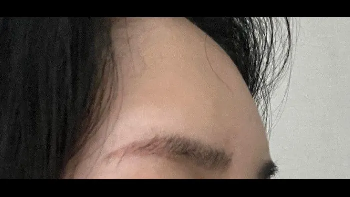 Lower Blepharoplasty (Aging Eye Rejuvenation), Midface Lift, Facial Fat Grafting — RE&RE PLASTIC SURGERY 3