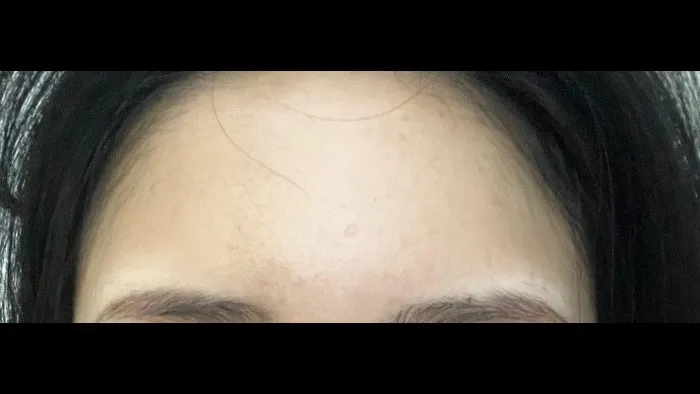 Lower Blepharoplasty (Aging Eye Rejuvenation), Midface Lift, Facial Fat Grafting — RE&RE PLASTIC SURGERY 4