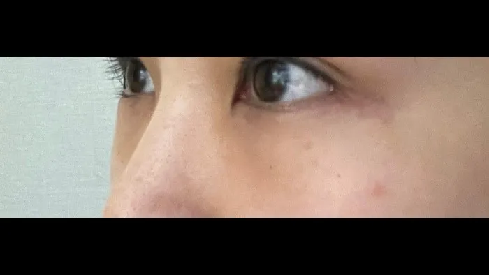Lower Blepharoplasty (Aging Eye Rejuvenation), Midface Lift, Facial Fat Grafting — RE&RE PLASTIC SURGERY 5