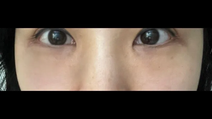 Lower Blepharoplasty (Aging Eye Rejuvenation), Midface Lift, Facial Fat Grafting — RE&RE PLASTIC SURGERY 6