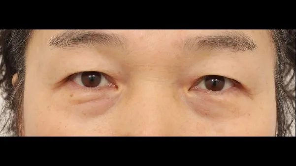 Sub-brow Lift, Ptosis Correction — RE&RE PLASTIC SURGERY 1