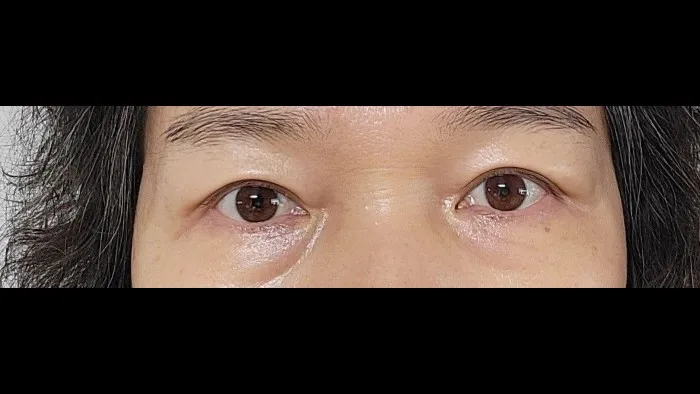 Sub-brow Lift, Ptosis Correction — RE&RE PLASTIC SURGERY 2