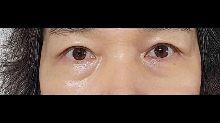 Sub-brow Lift, Ptosis Correction — RE&RE PLASTIC SURGERY 3