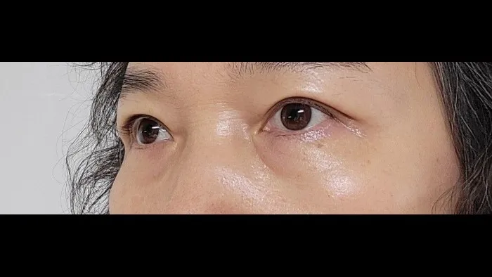 Sub-brow Lift, Ptosis Correction — RE&RE PLASTIC SURGERY 4