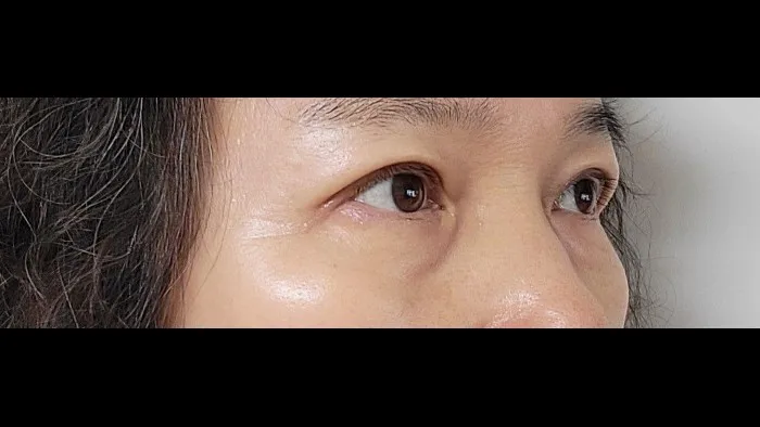 Sub-brow Lift, Ptosis Correction — RE&RE PLASTIC SURGERY 5