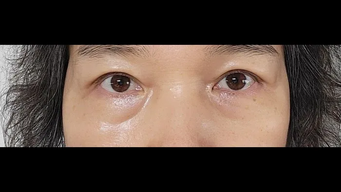 Sub-brow Lift, Ptosis Correction — RE&RE PLASTIC SURGERY 6