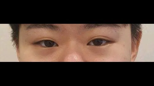 Nasal Tip, Nasal Bridge, Incisional Double Eyelid Surgery, Ptosis Correction — RE&RE PLASTIC SURGERY 1