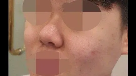 Nasal Tip, Nasal Bridge, Incisional Double Eyelid Surgery, Ptosis Correction 2
