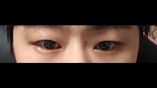 Nasal Tip, Nasal Bridge, Incisional Double Eyelid Surgery, Ptosis Correction — RE&RE PLASTIC SURGERY 3