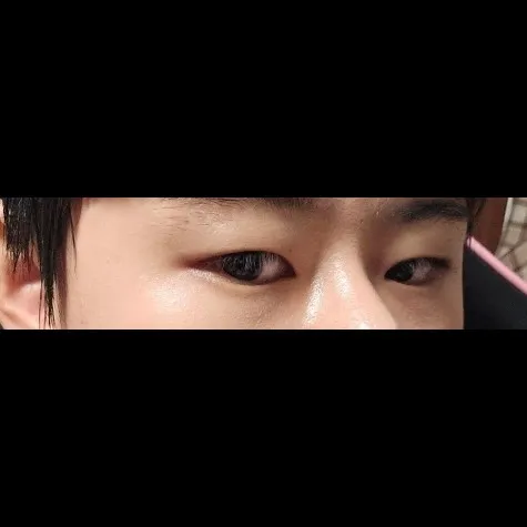 Nasal Tip, Nasal Bridge, Incisional Double Eyelid Surgery, Ptosis Correction — RE&RE PLASTIC SURGERY 4