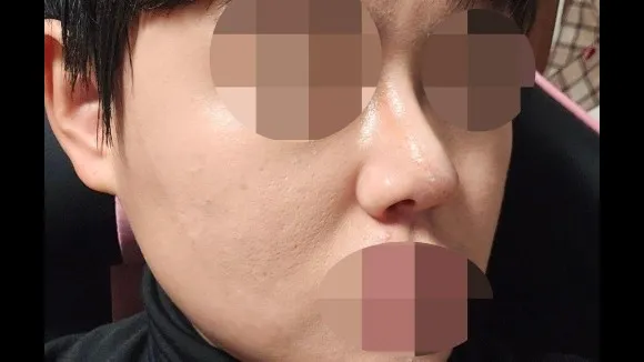 Nasal Tip, Nasal Bridge, Incisional Double Eyelid Surgery, Ptosis Correction — RE&RE PLASTIC SURGERY 5