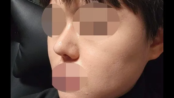 Nasal Tip, Nasal Bridge, Incisional Double Eyelid Surgery, Ptosis Correction — RE&RE PLASTIC SURGERY 6