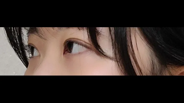 Natural Adhesion Double Eyelid Surgery, Ptosis Correction — RE&RE PLASTIC SURGERY 2