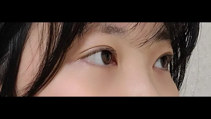 Natural Adhesion Double Eyelid Surgery, Ptosis Correction — RE&RE PLASTIC SURGERY 3