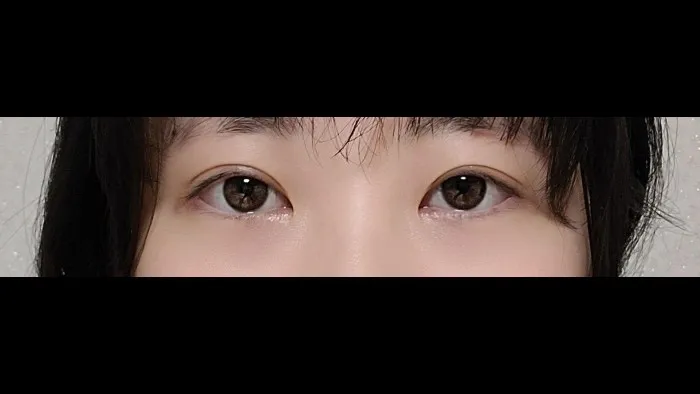 Natural Adhesion Double Eyelid Surgery, Ptosis Correction — RE&RE PLASTIC SURGERY 4