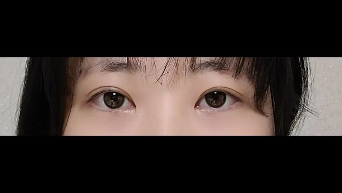 Natural Adhesion Double Eyelid Surgery, Ptosis Correction — RE&RE PLASTIC SURGERY 5