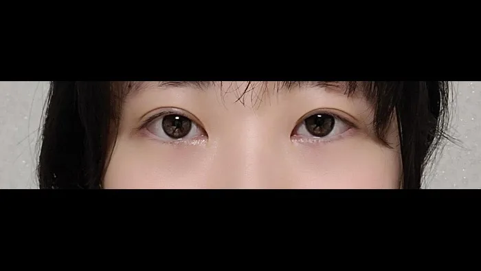 Natural Adhesion Double Eyelid Surgery, Ptosis Correction — RE&RE PLASTIC SURGERY 6