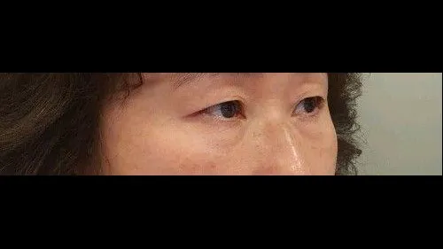 Sub-brow Lift, Lower Blepharoplasty (Aging Eye Rejuvenation) — RE&RE PLASTIC SURGERY 2