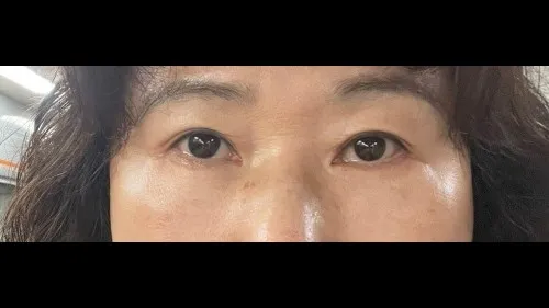 Sub-brow Lift, Lower Blepharoplasty (Aging Eye Rejuvenation) — RE&RE PLASTIC SURGERY 4