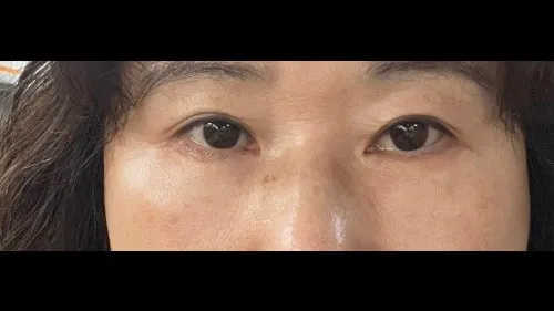 Sub-brow Lift, Lower Blepharoplasty (Aging Eye Rejuvenation) — RE&RE PLASTIC SURGERY 5