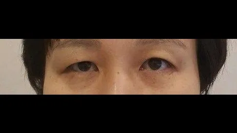Incisional Double Eyelid Surgery — RE&RE PLASTIC SURGERY 1