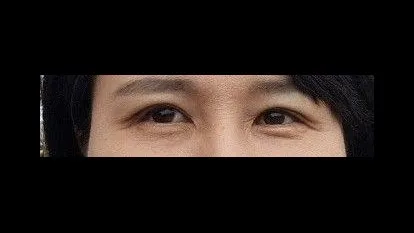 Incisional Double Eyelid Surgery — RE&RE PLASTIC SURGERY 2