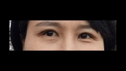 Incisional Double Eyelid Surgery — RE&RE PLASTIC SURGERY 3