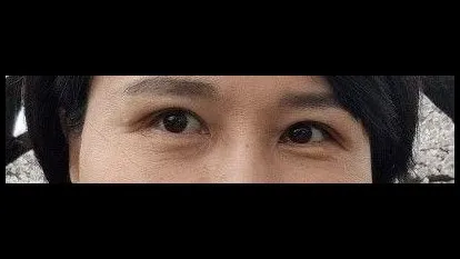 Incisional Double Eyelid Surgery — RE&RE PLASTIC SURGERY 4