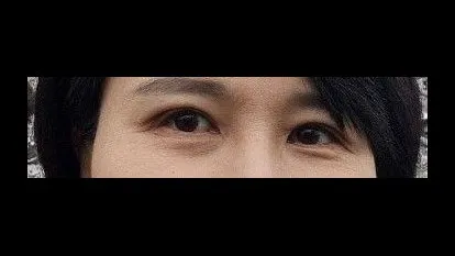 Incisional Double Eyelid Surgery — RE&RE PLASTIC SURGERY 5