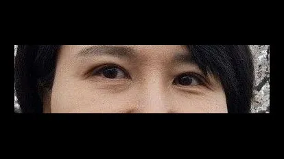 Incisional Double Eyelid Surgery — RE&RE PLASTIC SURGERY 6