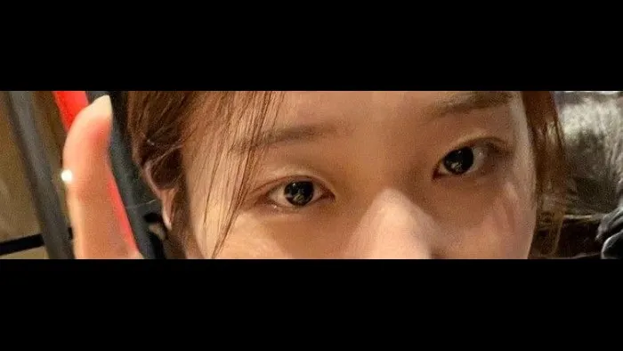 Natural Adhesion Double Eyelid Surgery — RE&RE PLASTIC SURGERY 2