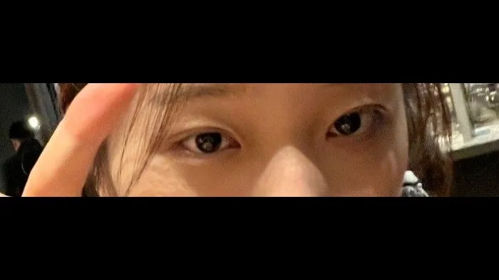 Natural Adhesion Double Eyelid Surgery — RE&RE PLASTIC SURGERY 3