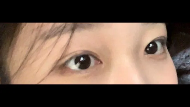 Natural Adhesion Double Eyelid Surgery — RE&RE PLASTIC SURGERY 4
