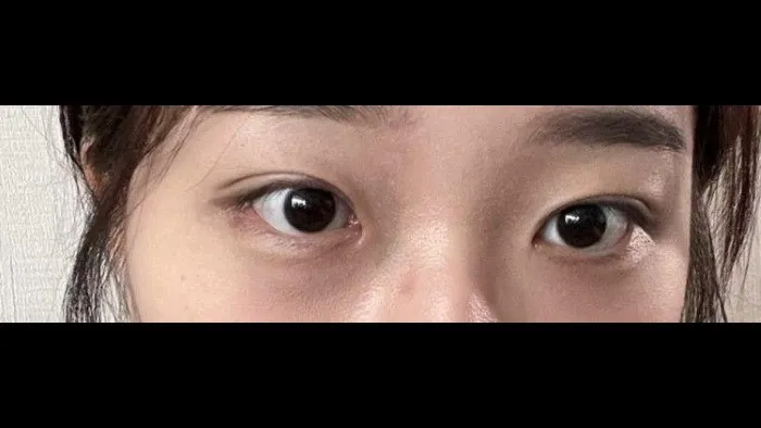 Natural Adhesion Double Eyelid Surgery — RE&RE PLASTIC SURGERY 5