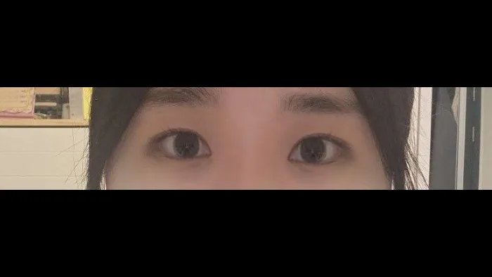 Partial Incision Double Eyelid Surgery, Ptosis Correction — RE&RE PLASTIC SURGERY 2