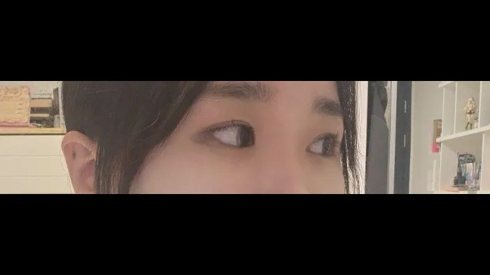 Partial Incision Double Eyelid Surgery, Ptosis Correction — RE&RE PLASTIC SURGERY 3