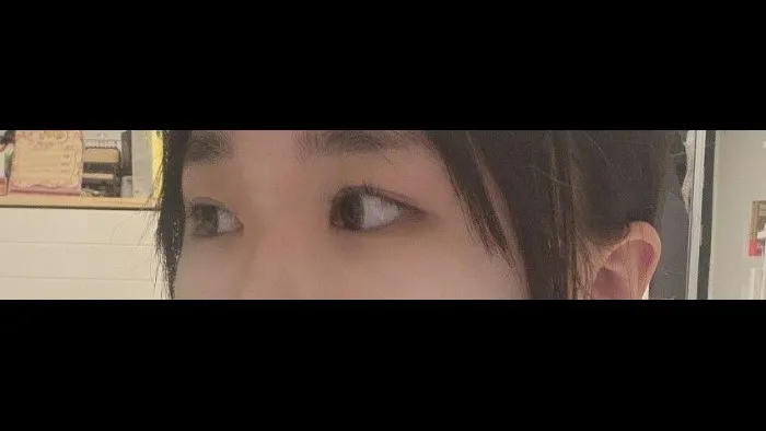 Partial Incision Double Eyelid Surgery, Ptosis Correction — RE&RE PLASTIC SURGERY 4