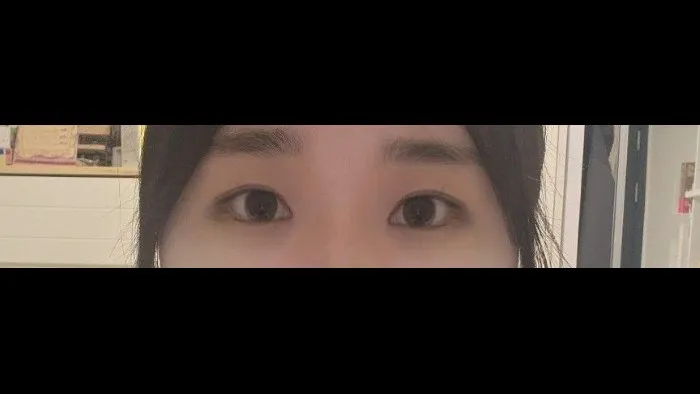 Partial Incision Double Eyelid Surgery, Ptosis Correction — RE&RE PLASTIC SURGERY 5