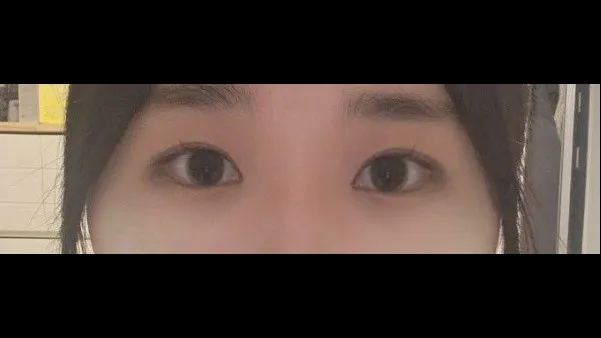 Partial Incision Double Eyelid Surgery, Ptosis Correction — RE&RE PLASTIC SURGERY 6