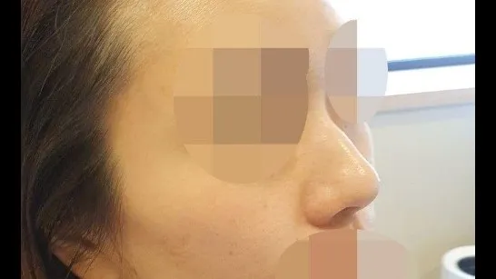 Nasal Tip, Nasal Bridge, Alar Base Reduction 1