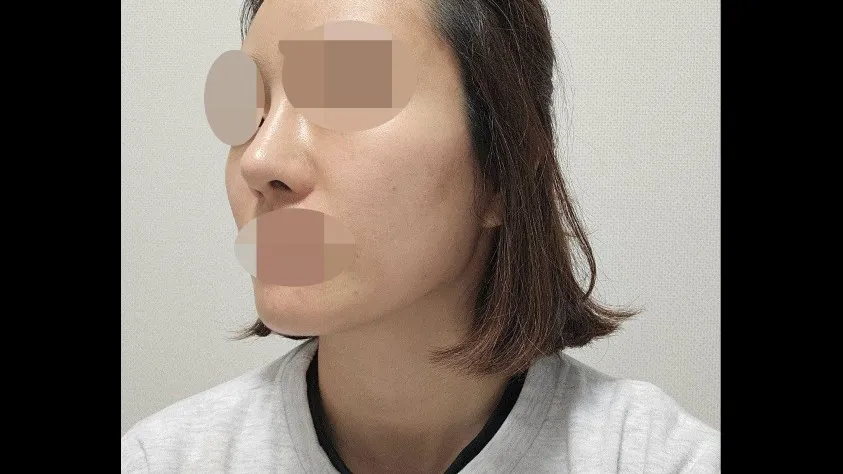 Nasal Tip, Nasal Bridge, Alar Base Reduction — RE&RE PLASTIC SURGERY 2