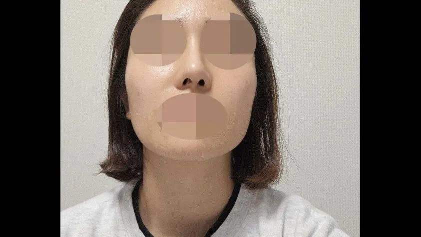 Nasal Tip, Nasal Bridge, Alar Base Reduction — RE&RE PLASTIC SURGERY 3