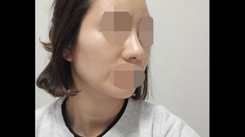 Nasal Tip, Nasal Bridge, Alar Base Reduction — RE&RE PLASTIC SURGERY 4