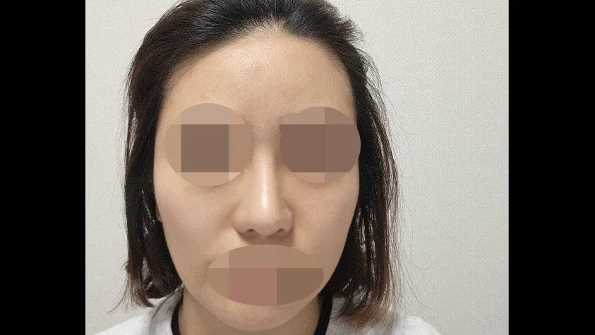 Nasal Tip, Nasal Bridge, Alar Base Reduction — RE&RE PLASTIC SURGERY 5