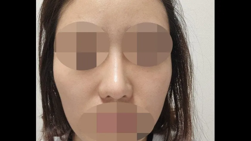 Nasal Tip, Nasal Bridge, Alar Base Reduction — RE&RE PLASTIC SURGERY 6
